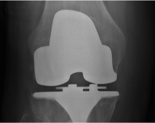 Implant Size Estimation for Health Care